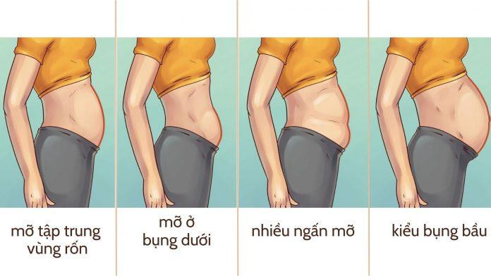 Các dạng béo bụng phổ biến