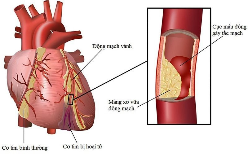 Chỉ số mỡ máu và ảnh hưởng đến sức khỏe tim mạch