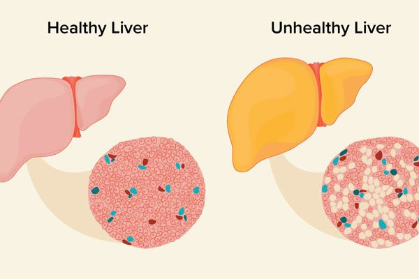 So sánh gan khỏe mạnh và gan mắc bệnh