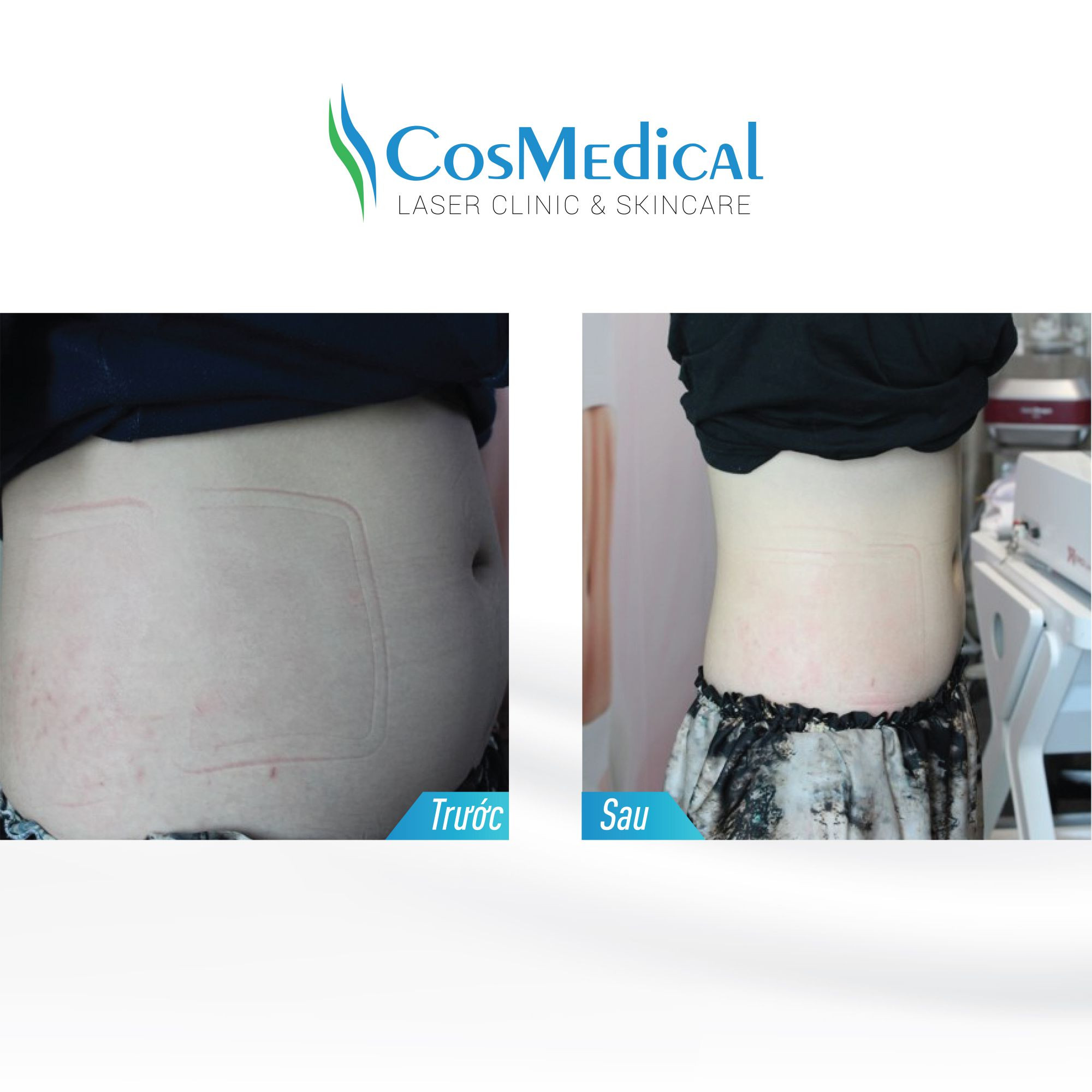 Thực tế khách hàng giảm béo tại CosMedical Clinic