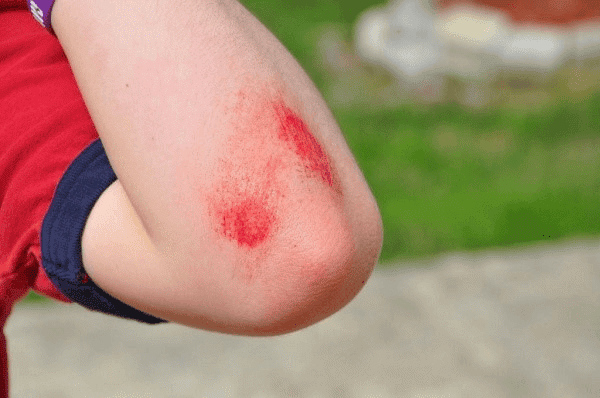 Neosporin: Công dụng, chỉ định và lưu ý khi sử dụng